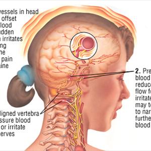 Migraines Causes Of - Treatment For Migraine Headaches