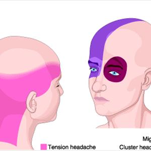 Will Fioricet Help A Headache - Headache - Tension Headache - Migraine Headache - The Simple Facts And The Cures