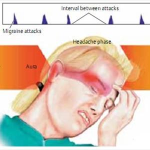 Occipital Migraine Definition - Tension Headache Causes, Symptoms And Home Remedies