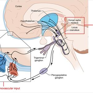 Migrainous Neuralgia Medical Definition - Migraine Headaches - Effective Natural Treatment Methods!