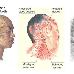 Natural Headache Remedy Or Remedies - Migraine Remedies