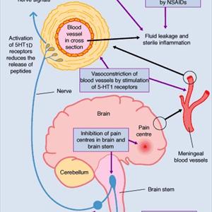 Complicated Migraine Phenomenon - Effective All Natural Home Migraine Remedies  That Relieve Pain Quickly