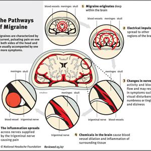 Excedrin Migraine Tablets - Living With Headache During Pregnancy