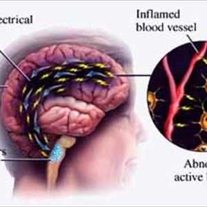 Migraine Medicines - After Exercise Headache - More Serious Than You Think?